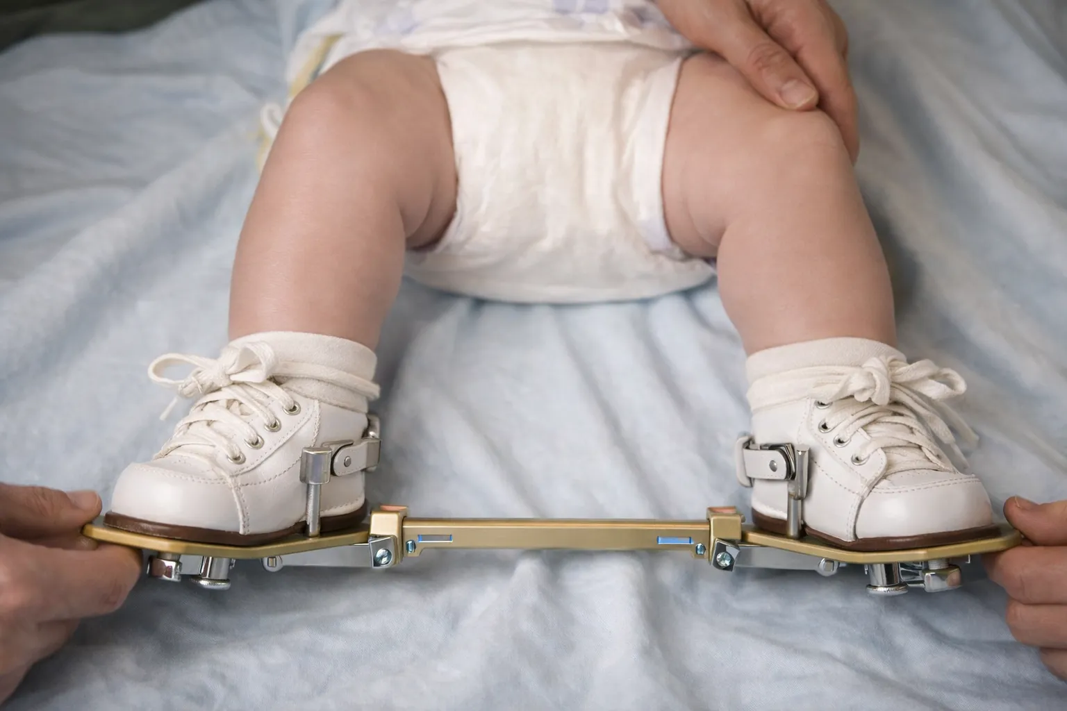 Clubfoot CTEV Treatment at Trinay Orthopedic Hospital